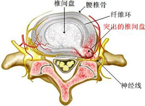 腰间盘突出的治疗好方法非常实用