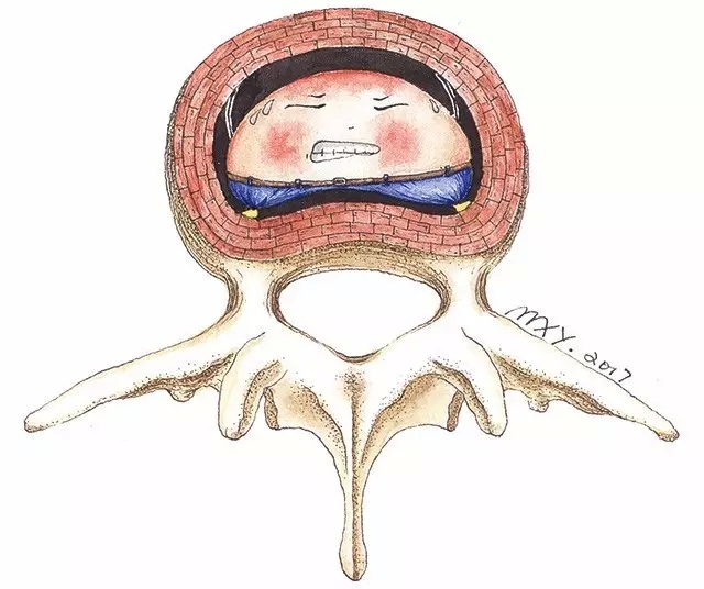 腰间盘突出如何进行治疗才能有很好的效果