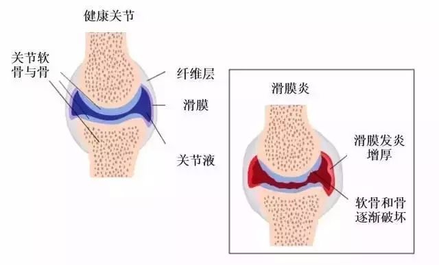 得了膝关节滑膜炎怎样治效果好