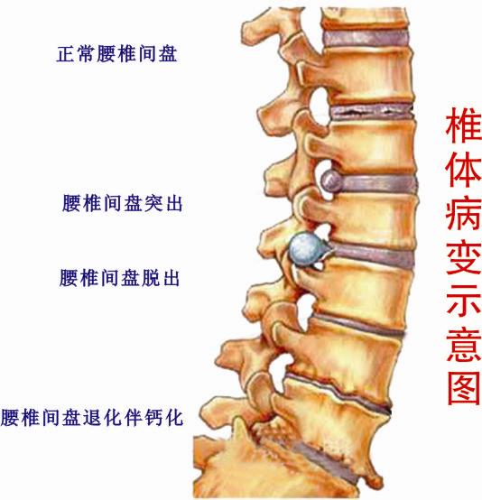 明星怎么治疗腰椎间盘突出你意想不到_1