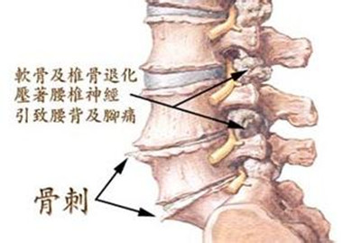 看腰椎间盘突出危害在不改善就悔了图