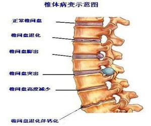 腰椎间盘突出质量方法多教你最有用的