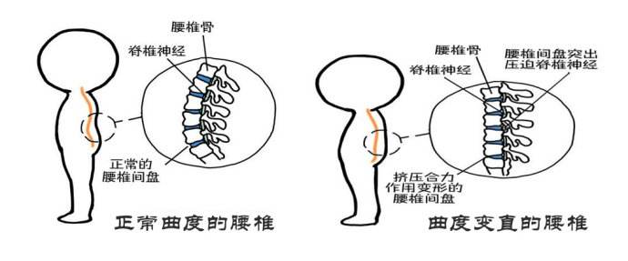 腰椎间盘突出一般是什么问题导致的好方法在这里(图)
