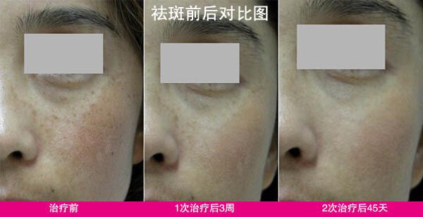 秀靚美容院祛斑產(chǎn)品使用效果咋樣_1