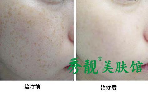 秀靚美容院祛斑怎么樣 用過再說話_1