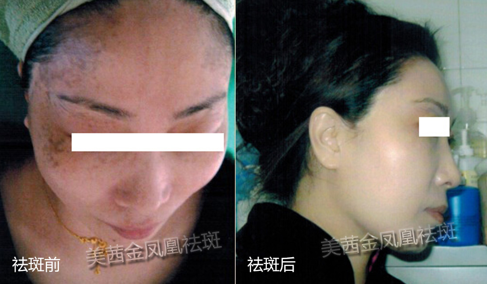 南京美茜金鳳凰一次性祛斑采用的是什么方法_4