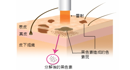 洛纳丹蒂为你揭秘2016年最赚钱的祛斑技术（图）_3