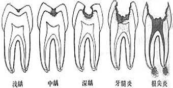 口腔執(zhí)業(yè)醫(yī)告訴您師牙骨質(zhì)齲的病理變化（圖）_2
