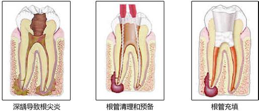 郑州口腔执业医师之常见牙髓变性的病理变化（图）_2