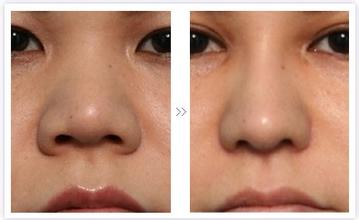 商丘做鼻子比較好的醫(yī)院？（圖）_1