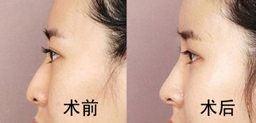商丘華美鼻綜合整形（圖）_1