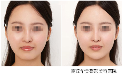 商丘假體墊下巴多久可以消腫？（圖）_1