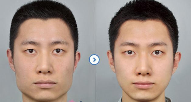 商丘下頜角整形手術痛嗎 效果怎樣？（圖）_3