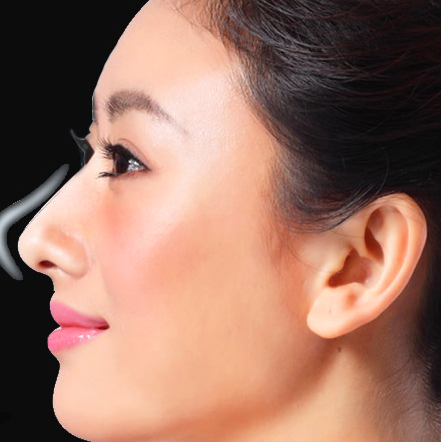 商丘隆鼻失敗后該怎么修復(fù)?（圖）_1