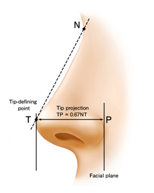 商丘隆鼻失敗后該怎么修復(fù)?（圖）_2