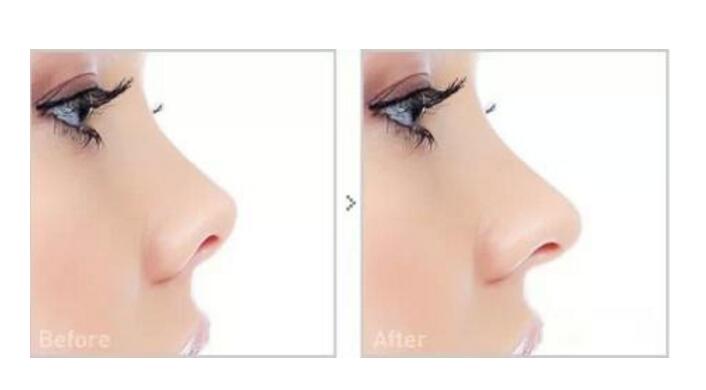 商丘駝峰鼻矯正（圖）_1