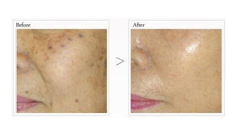 商丘哪種方法去除老年斑效果好？（圖）_1