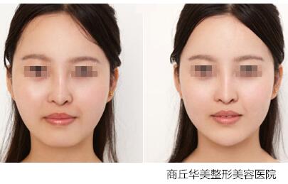 商丘豐下巴是注射好還是手術(shù)好？（圖）_1