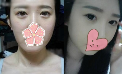 商丘哪家去眼袋手術(shù)不留疤?（圖）_1