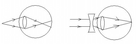 近視、遠視、老花，傻傻分不清_2