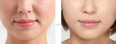 商丘怎么改善鼻唇溝？（圖）_1