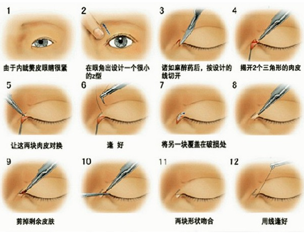 商丘開內(nèi)眼角大概多少錢？（圖）_2