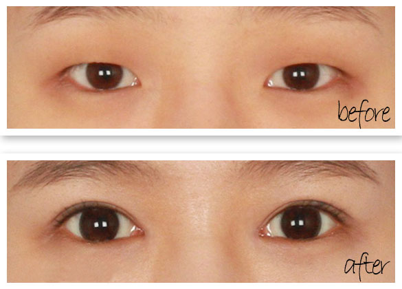 商丘開內(nèi)眼角大概多少錢？（圖）_3