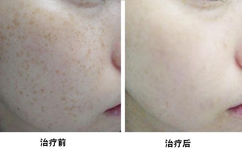 商丘激光祛斑的價(jià)格是多少?（圖）_1
