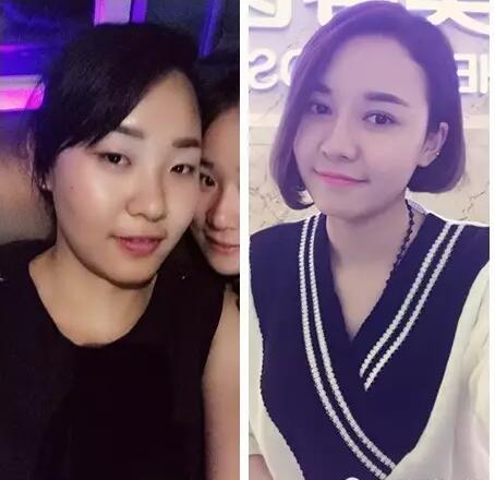 商丘華美朱紀國醫(yī)生修復雙眼皮怎么樣?（圖）_2