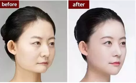 商丘玻尿酸隆鼻加豐下巴（圖）_3
