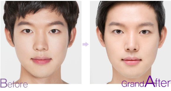 商丘男士做隆鼻需要多少錢?。▓D）_1