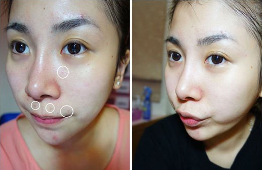 商丘有誰(shuí)果酸換膚過(guò)嗎（圖）_1