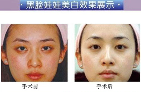 商丘哪家醫(yī)院可以做黑臉娃娃？（圖）_1