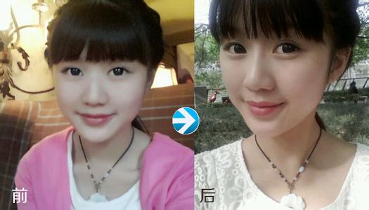 商丘自體軟骨墊鼻子多少錢(qián)（圖）_1