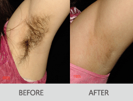 在商丘脫腋毛價(jià)格是多少呢？（圖）_1