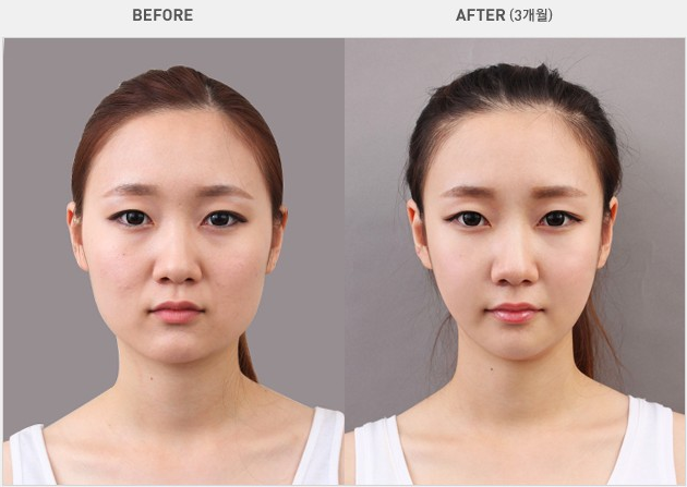 在商丘做下頜角削骨瘦臉的話需要多少錢呢?（圖）_1