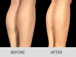 商丘注射瘦腿針后會不會反彈呢?（圖）_1