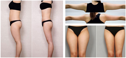 商丘做吸脂瘦身手術(shù)的哪里好？（圖）_2