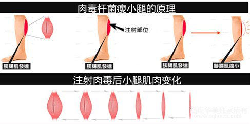 商丘吸脂瘦小腿和瘦腿针效果哪个好？（图）_4