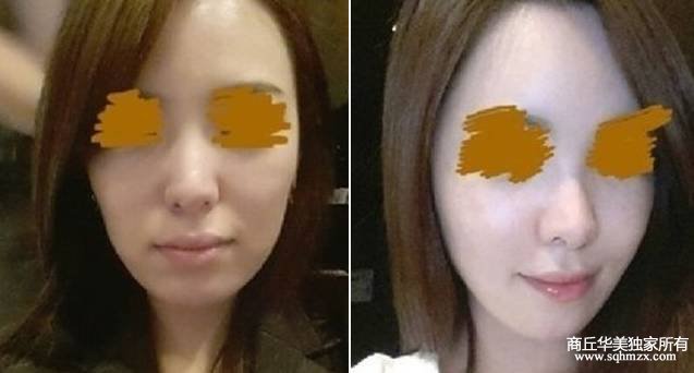 商丘哪家醫(yī)院自體脂肪填充效果好？（圖）_1