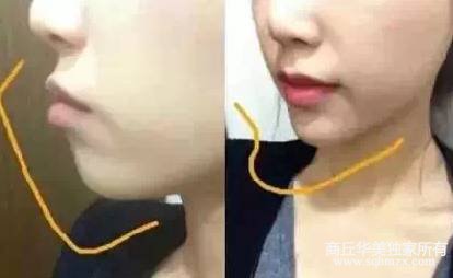 商丘哪家醫(yī)院自體脂肪填充效果好？（圖）_3