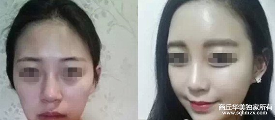 商丘哪家醫(yī)院自體脂肪填充效果好？（圖）_4