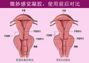 产后松弛怎么办？缩阴产品帮到你（图）_4