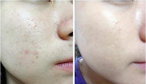 商丘毛孔粗大怎么改善？光子嫩膚效果？（圖）_1