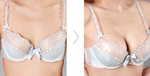 商丘乳房下垂矯正術(shù)（圖）_1