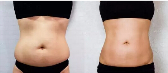 商丘華美水動(dòng)力吸脂手術(shù)效果怎么樣？（圖）_1