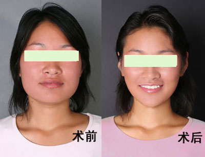 商丘瘦臉針對比案例（圖）_1
