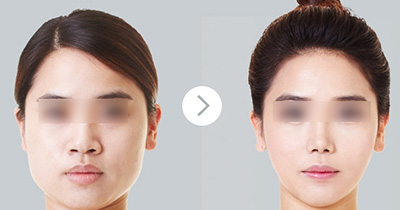 商丘瘦臉針對比案例（圖）_2