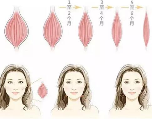 商丘打完瘦臉針多久能變瘦？（圖）_1