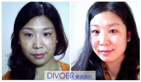 產(chǎn)后斑怎么去除 香蕉加牛奶能祛斑嗎（圖）_2